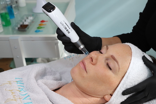 Microneedling