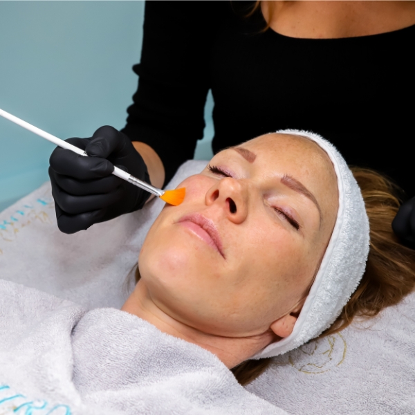 Resultaat van een medische peeling voor een frisse, egale en gezonde huid