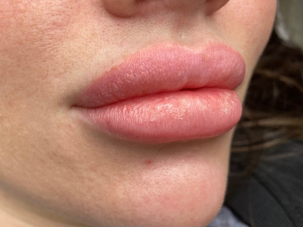 Na de PMU lippen behandeling met een frisse natuurlijke kleur en meer definitie.