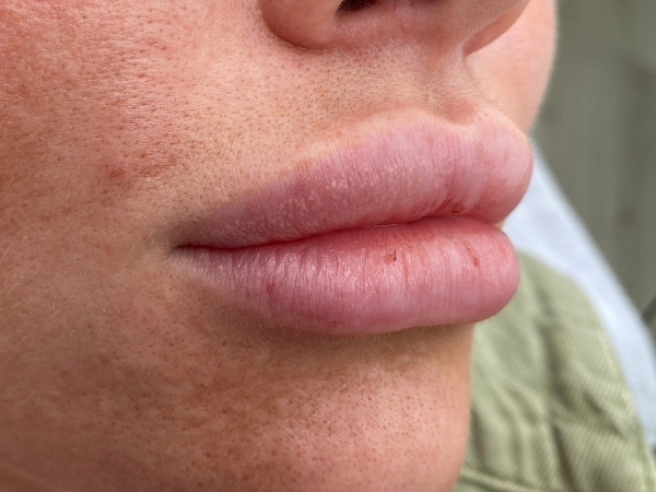 Voor de PMU lippen behandeling met een bleke lipkleur en weinig definitie.