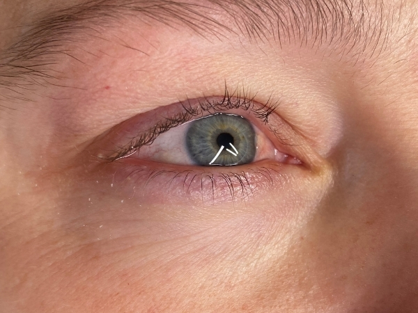 Voor de PMU ogen behandeling met een natuurlijke oogopslag zonder permanente eyeliner.