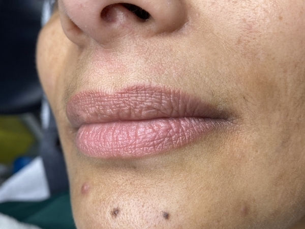 After foto van resultaat PMU Lippen behandeling.