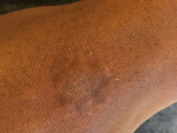 Nafoto van littekkens op een arm na een behandeling voor medische camouflage met een natuurlijker huidbeeld.