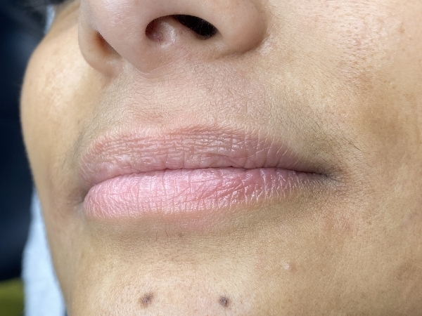 Before foto van resultaat PMU Lippen behandeling.