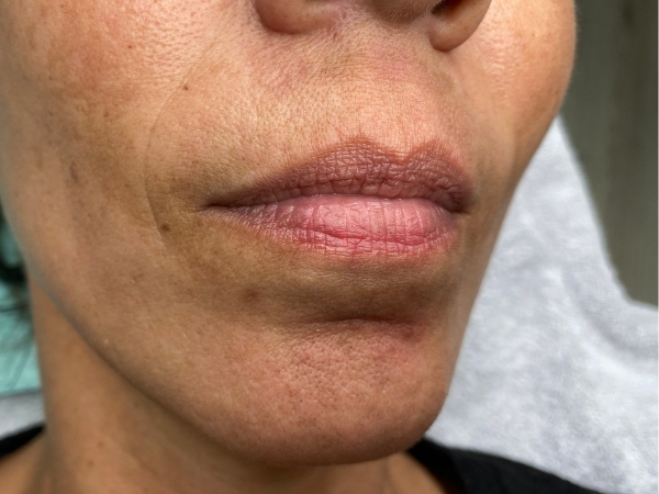 Voorfoto van de lippen vóór een Full Lips PMU-behandeling.