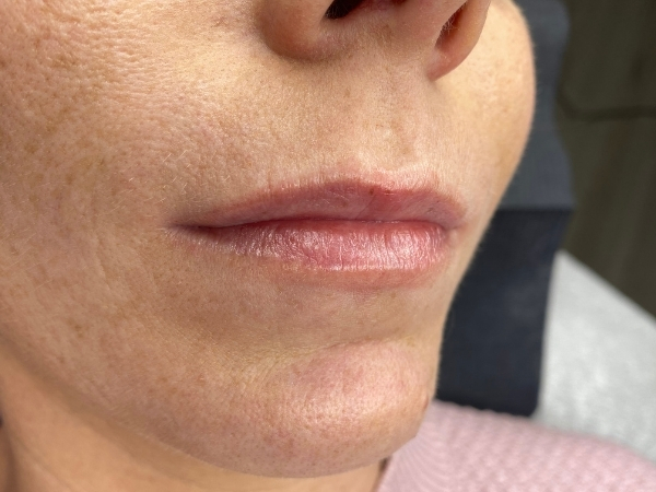 Voorfoto van lippen vóór een Full Lips PMU-behandeling.