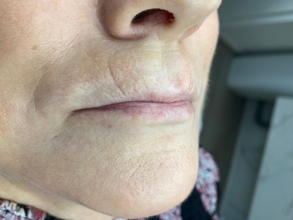 Voorfoto van lippen vóór een Full Lips permanente make-up behandeling.