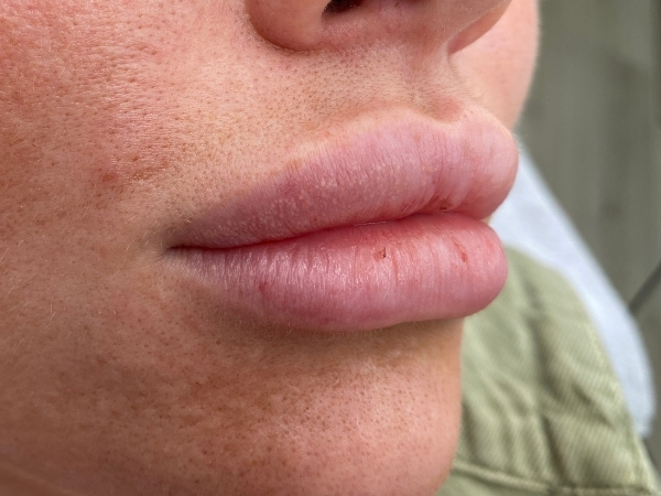 Voorfoto van lippen vóór een Lip Blush permanente make-up behandeling.