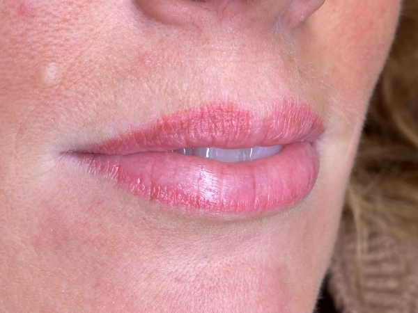 Voorfoto van lippen vóór een lip PMU-behandeling.