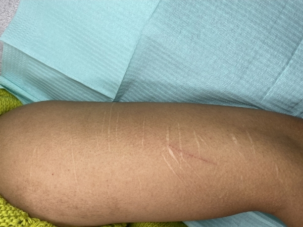 Voorfoto van zichtbare littekens vóór een behandeling voor medische camouflage.