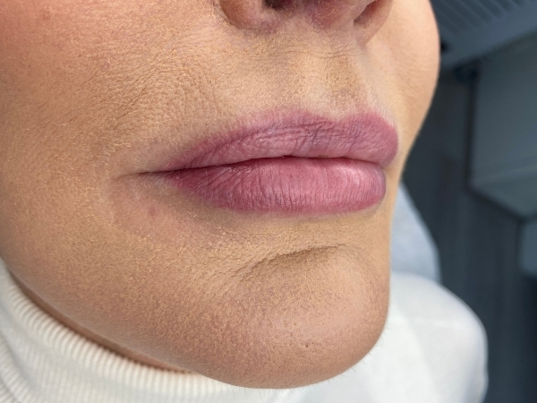 Voorfoto van oude lip PMU met vervaagde pigmentatie vóór een correctiebehandeling.