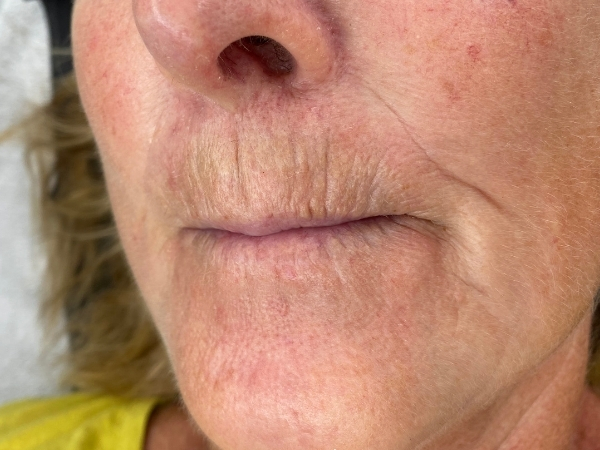 Voorfoto van oude lip PMU vóór een correctiebehandeling.